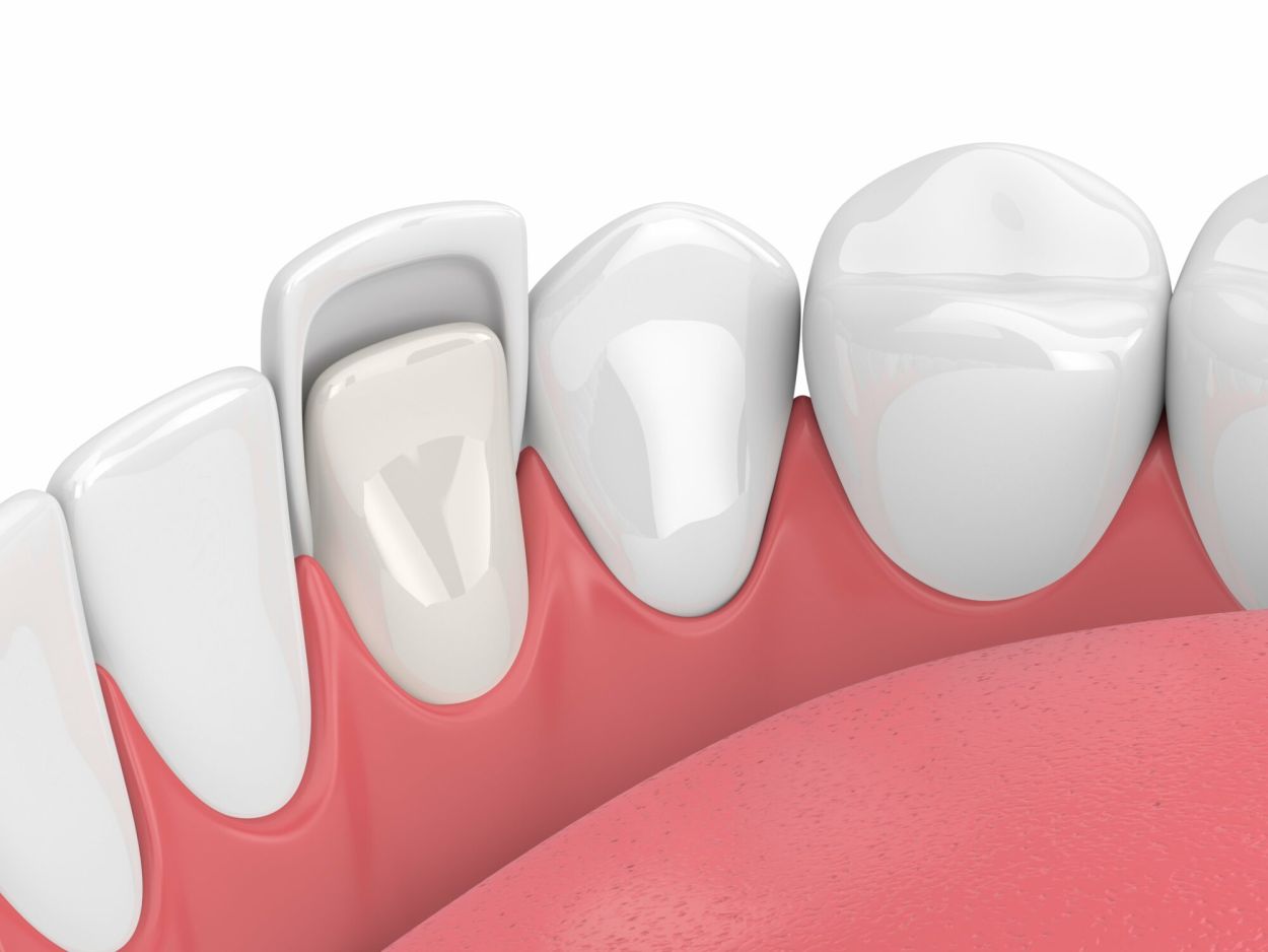 composite veneers