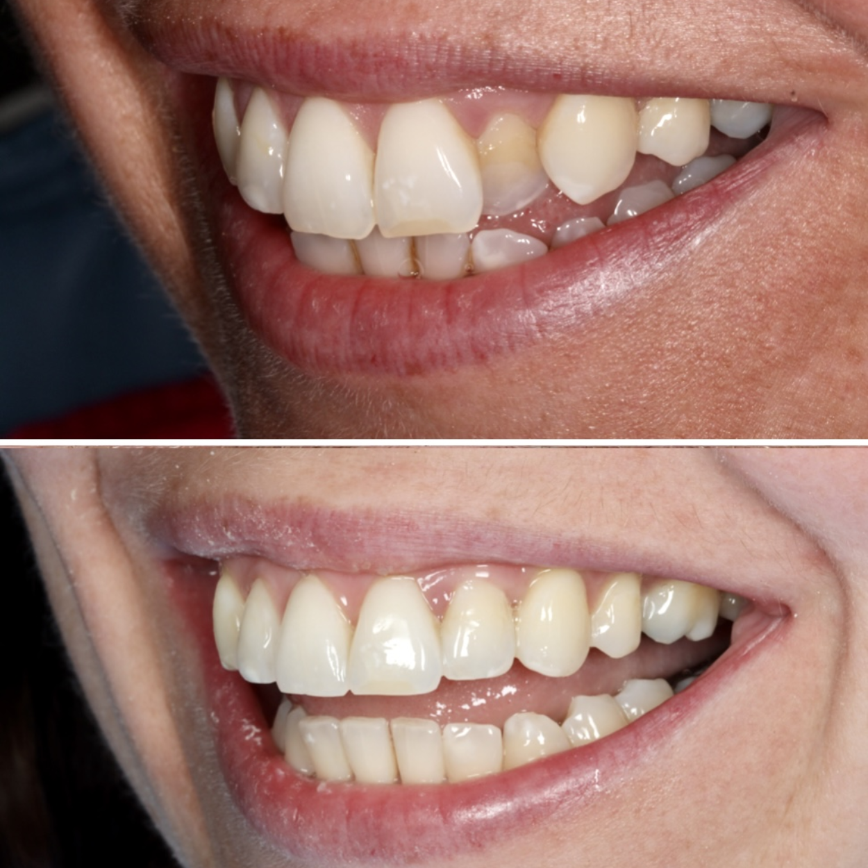 before and after invisalign